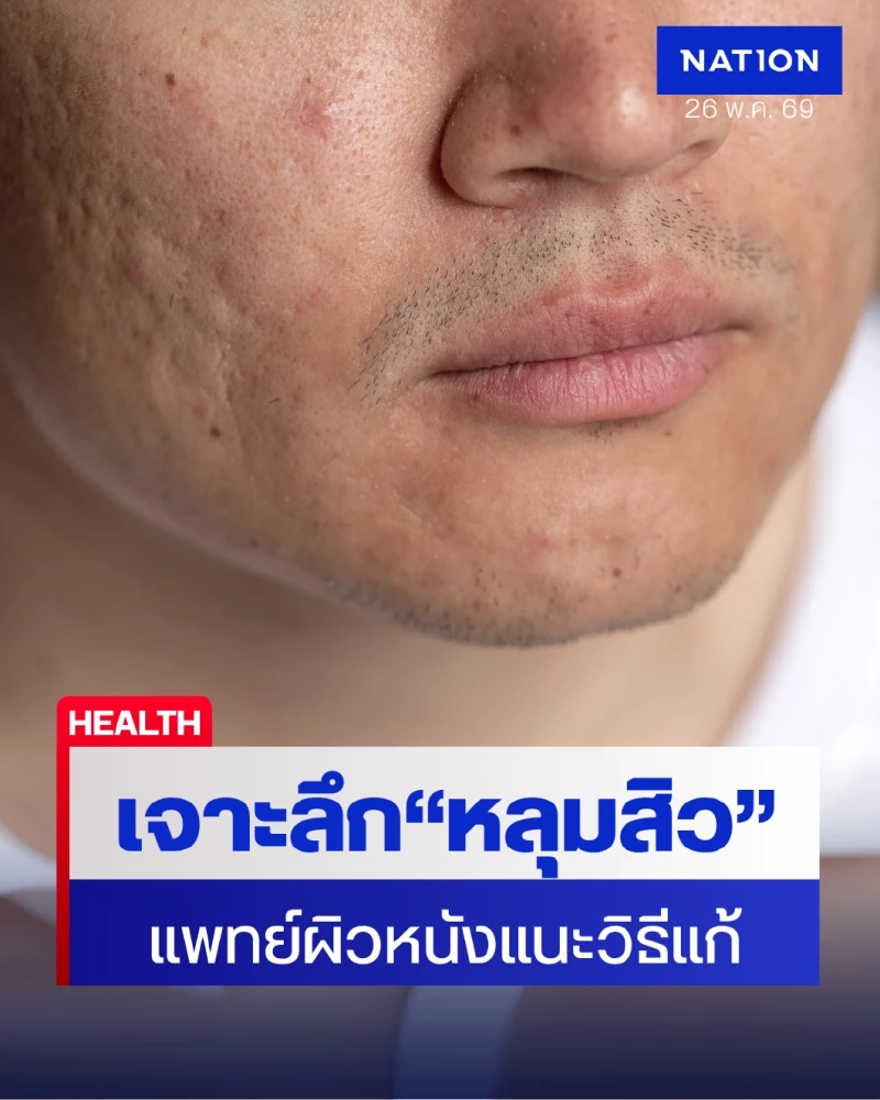 รู้จัก “หลุมสิว” ปัญหาผิวที่รักษาได้ หากดูแลตั้งแต่ต้นเหตุ